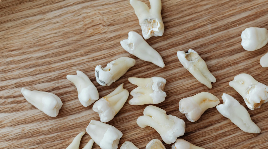 Carie dentali: cause, prevenzione e trattamenti